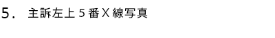 主訴左上5番X線写真