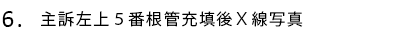 主訴左上5番根管充填後X線写真