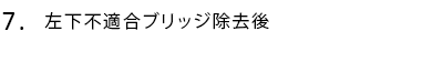 左下不適合ブリッジ除去後