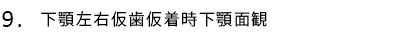 下顎左右仮歯仮着時下顎面観