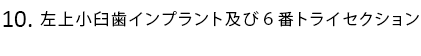 左上小臼歯インプラント及び6番トライセクション