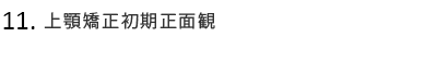 上顎矯正初期正面観