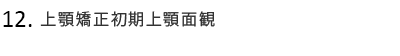 上顎矯正初期上顎面観