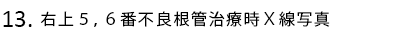 右上5,6番不良根管治療時X線写真