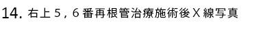 右上5,6番再根管治療施術後X線写真