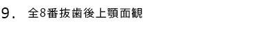 全8番抜歯後上顎面観