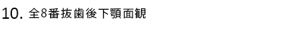 全8番抜歯後下顎面観