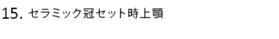 セラミック冠セット時上顎