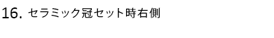 セラミック冠セット時右側