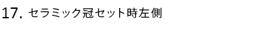 セラミック冠セット時左側