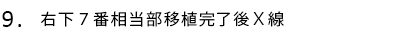 右下7番相当部移植完了後X線