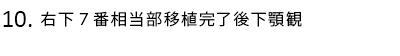 右下7番相当部移植完了後下顎観