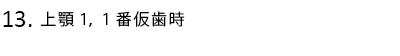 上顎1,1番仮歯時