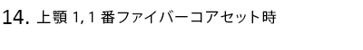 上顎1,1番ファイバーコアセット時