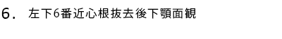 左下6番近心根抜去後下顎面観