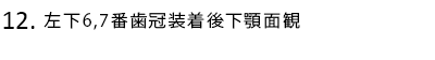 左下6,7番歯冠装着後下顎面観