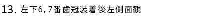 左下6,7番歯冠装着後左側面観
