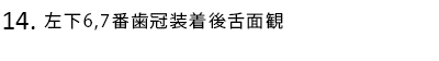 左下6,7番歯冠装着後舌面観
