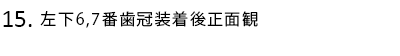 左下6,7番歯冠装着後正面観