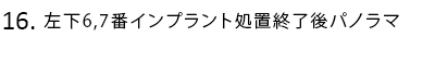 左下6,7番インプラント処置終了後パノラマ